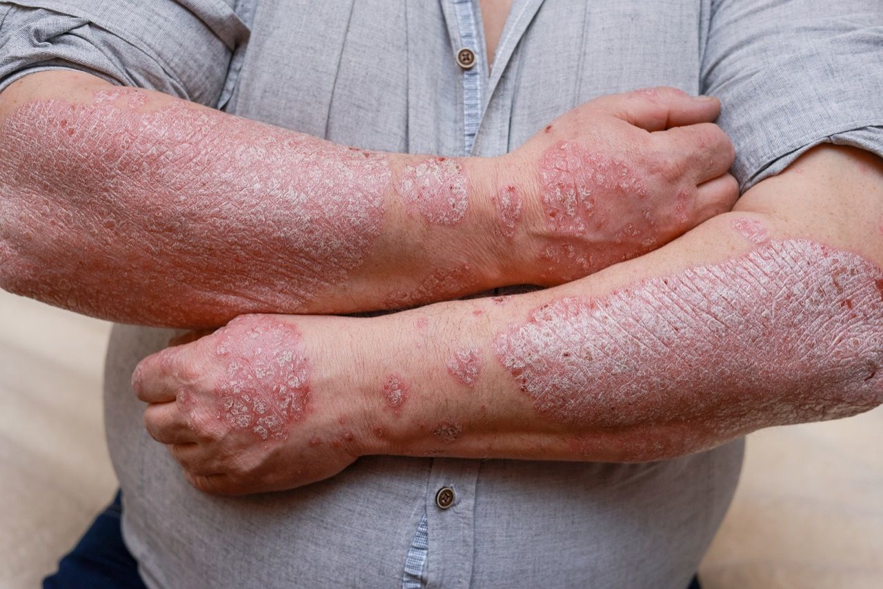 What is Psoriasis?