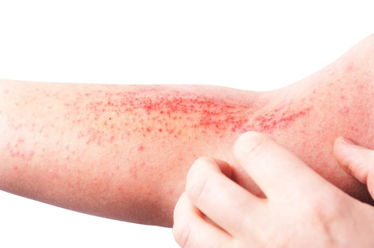 What is Atopic Dermatitis?